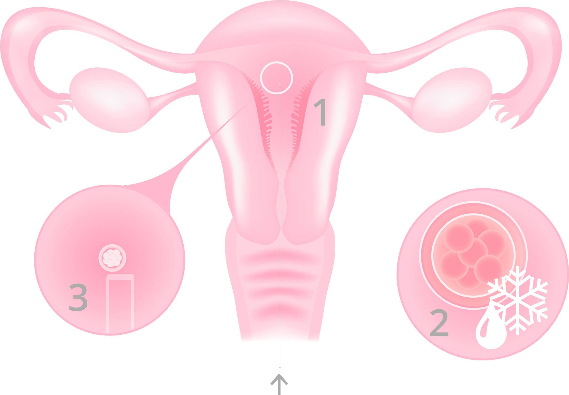 Trasferimento di embrioni - Infografica